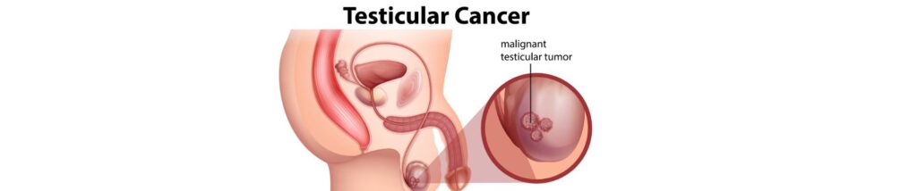 Καρκίνος Όρχεων